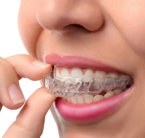 Allineatori trasparenti per il tuo sorriso