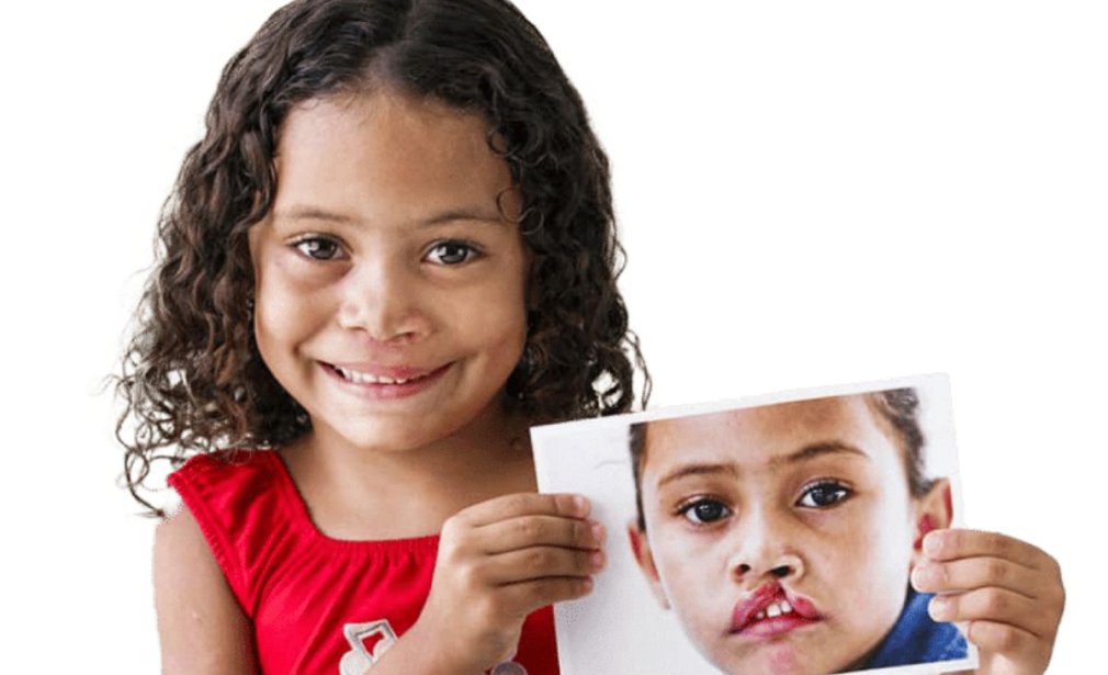 Ortodonzia in esiti di labiopalatoschisi presso lo studio dentistico Semeraro a Martina Franca
