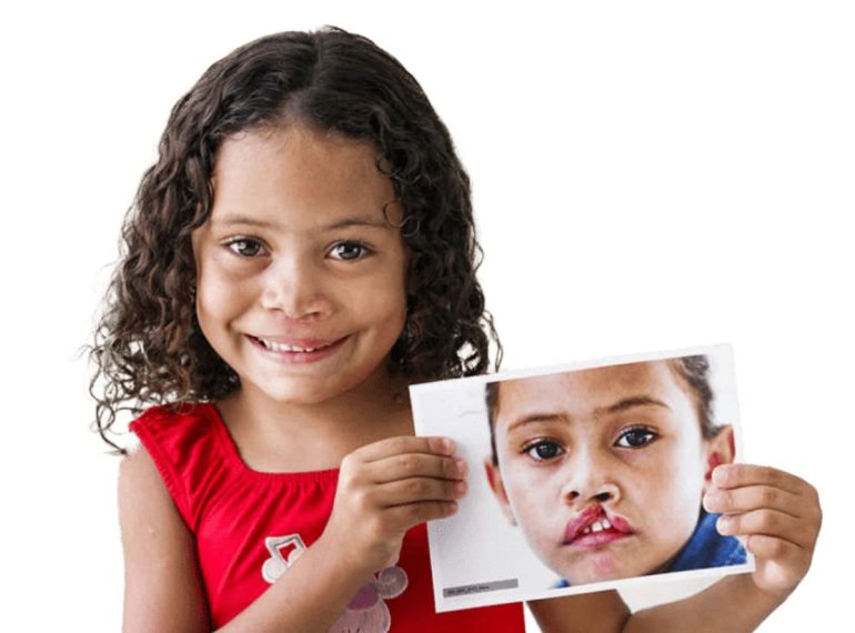Ortodonzia in esiti di labiopalatoschisi presso lo studio dentistico Semeraro a Martina Franca