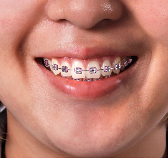 sorriso e denti con apparecchio