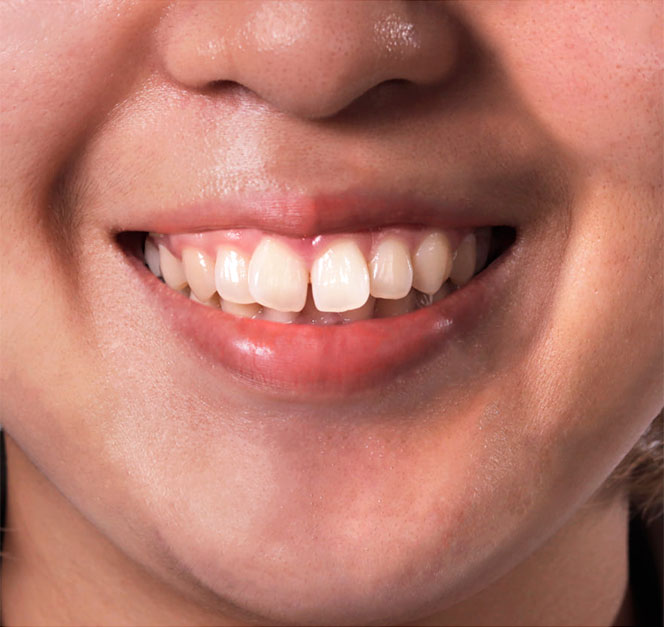 sorriso e denti senza apparecchio